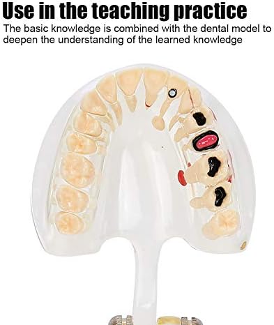 Diş Diş Modeli, Patolojik Çıkarılabilir Diş Modeli Öğretim Aracı Gösteri Modeli için Diş Hekimi Öğretim Ağız Bakımı